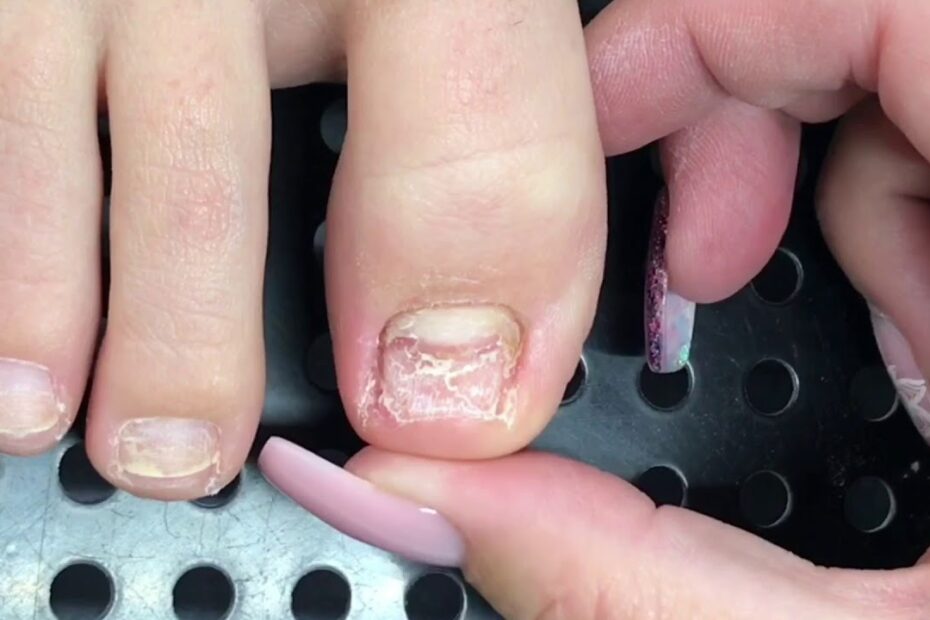 How Much Is Toenail Reconstruction? New Update