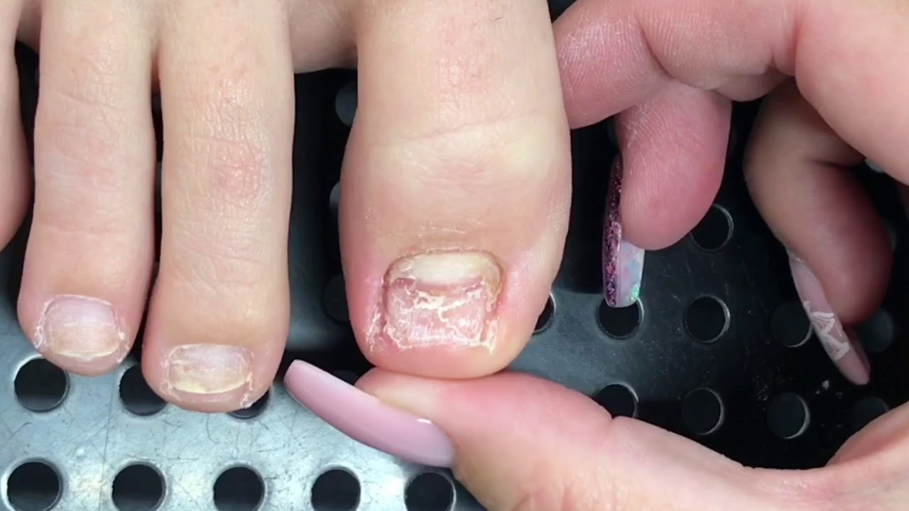 How Much Is Toenail Reconstruction