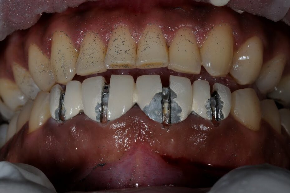 How Does A Dentist Remove A Permanent Crown