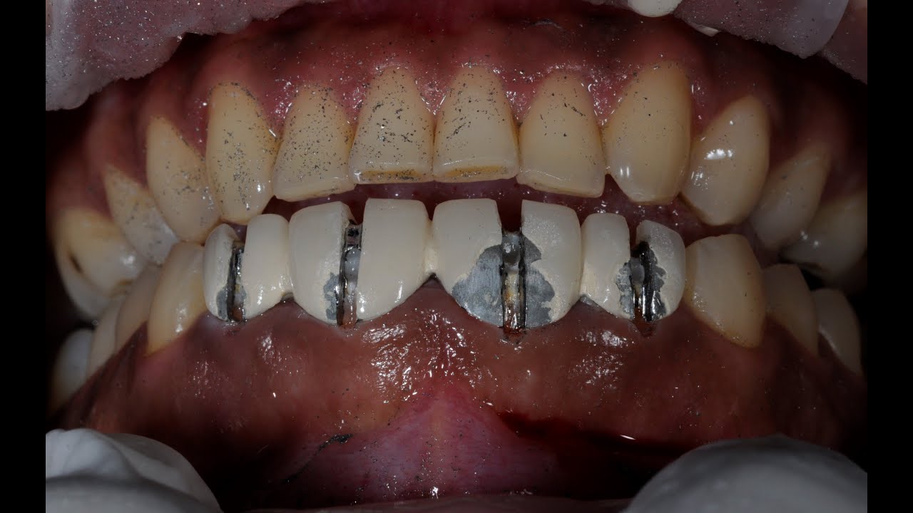 How Does A Dentist Remove A Permanent Crown