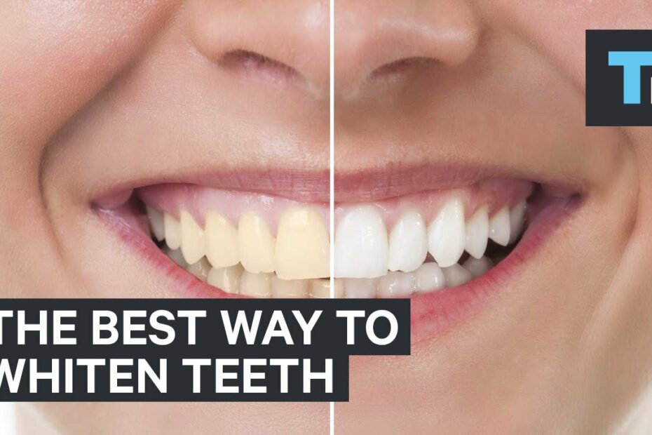 How Long Does It Take To Whiten Your Teeth