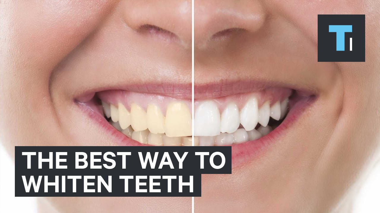 How Long Does It Take To Whiten Your Teeth