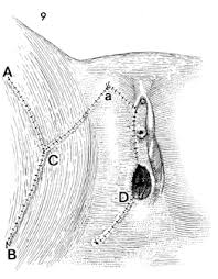 Cpt Code For Excision Of Vulvar Lesion: What You Need To Know