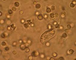 Pus Cells In Urine 4-6 Hpf: What Does It Mean?