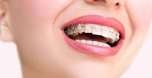 Braces Are Not Worth It: The Truth About Orthodontics