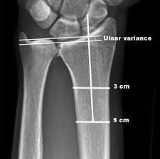 Is Ulnar Impaction Syndrome A Disability?